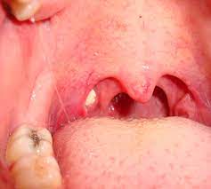 How to make tonsils stones fall out? All that you have to know about tonsils stones